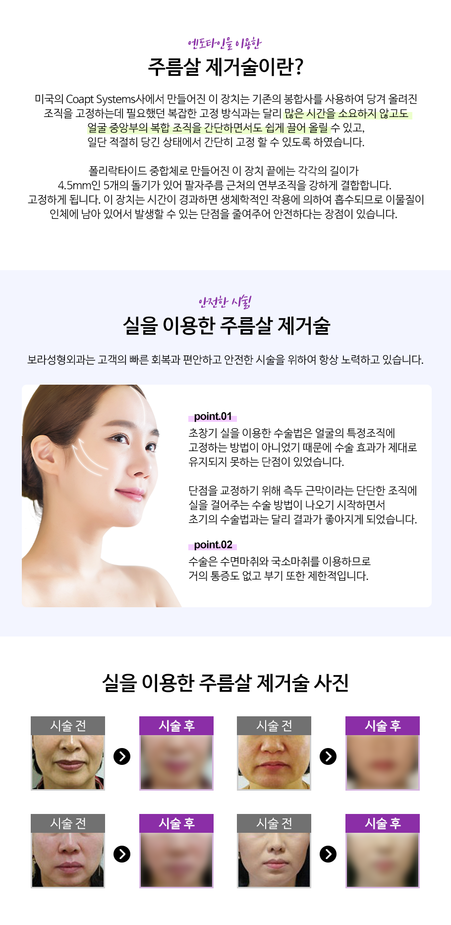 안면주름